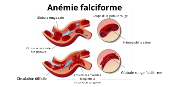 anemie_falciforme2